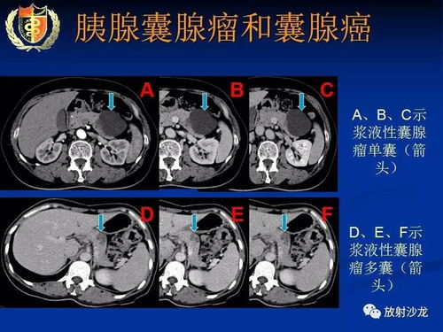 胰腺病有啥症状