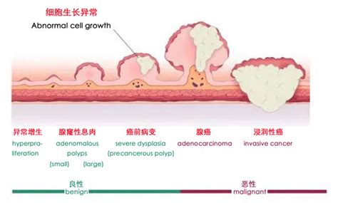 肠息肉的症状表现会大便不成形吗